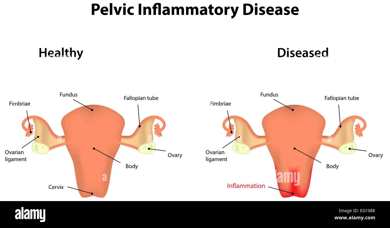Pelvic Inflammatory Disease Stock Vector