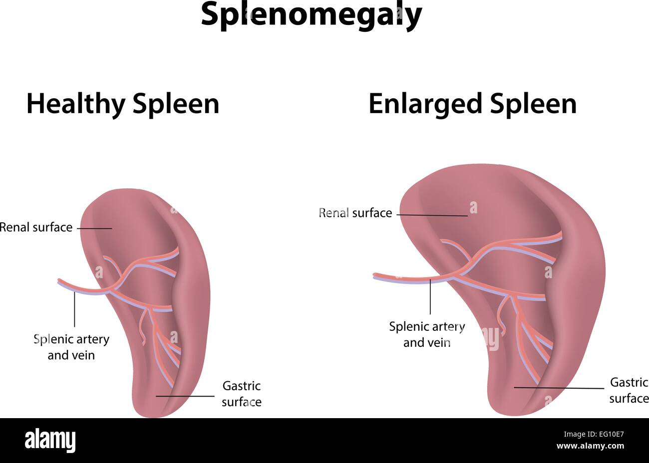 normal and enlarged spleen