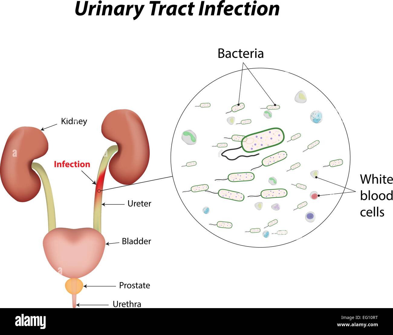 Urinary Tract Infection Stock Vector