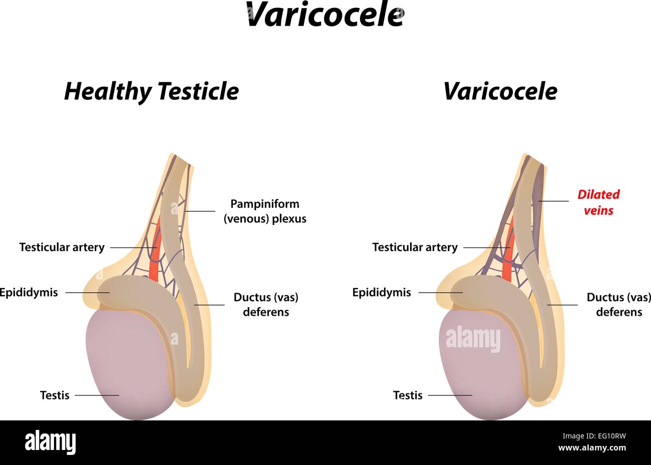 Varicocele Surgery Montreal