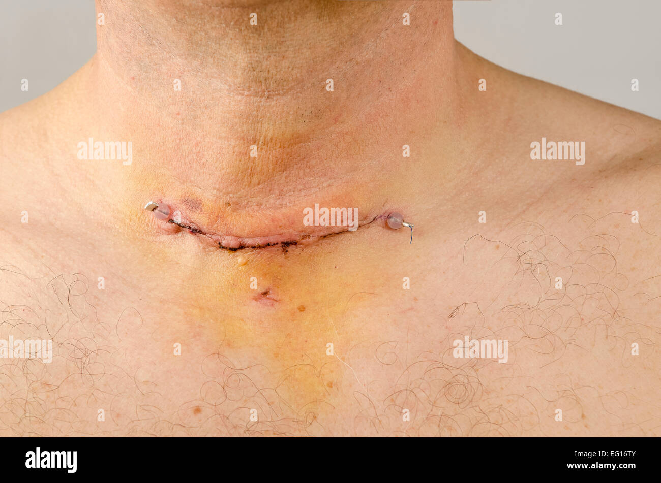 post operative scar wound and stitch of thyroidectomy also showing where drain was inserted release available for certain uses Stock Photo