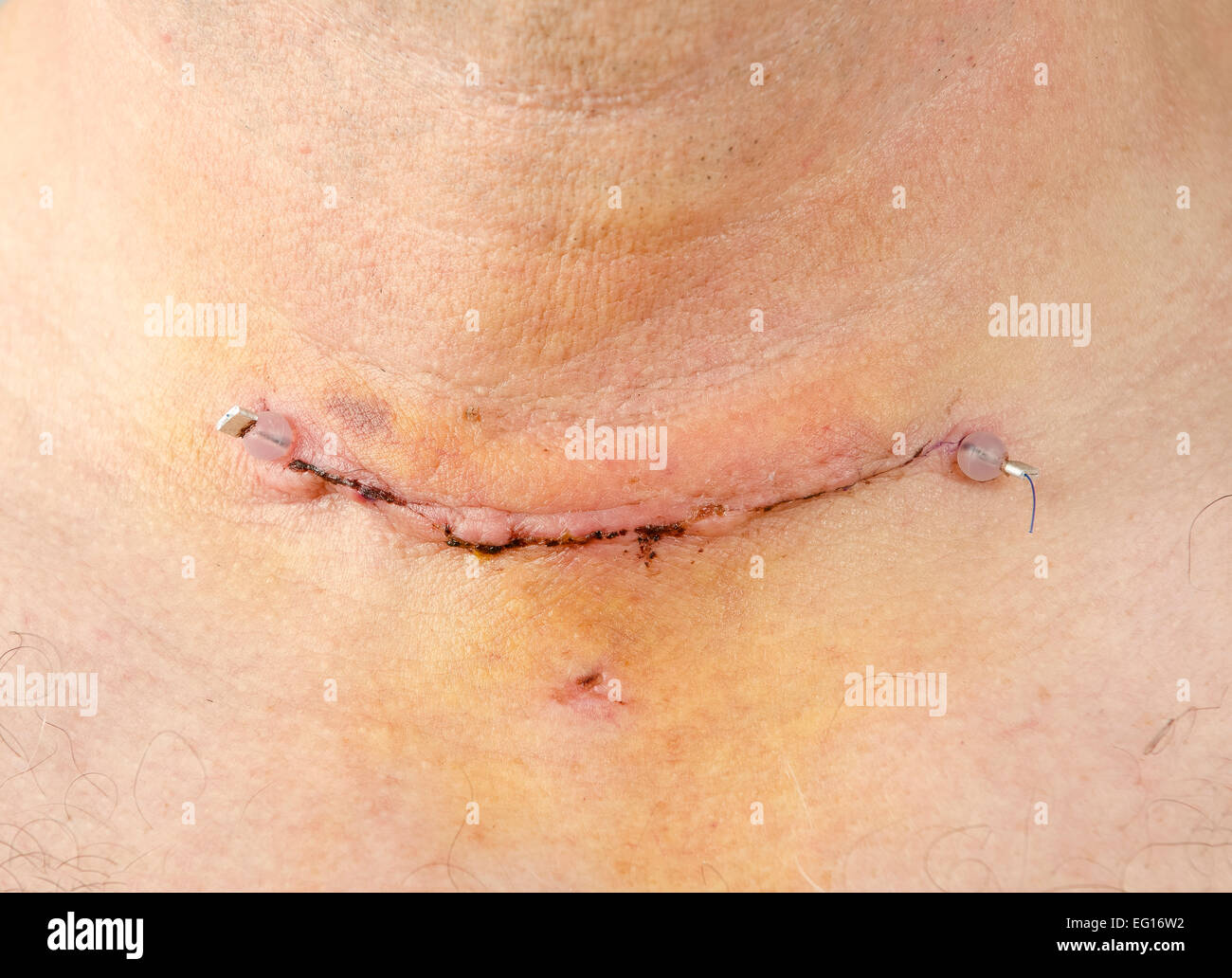 post operative scar wound and stitch of thyroidectomy also showing where drain was inserted release available for certain uses Stock Photo