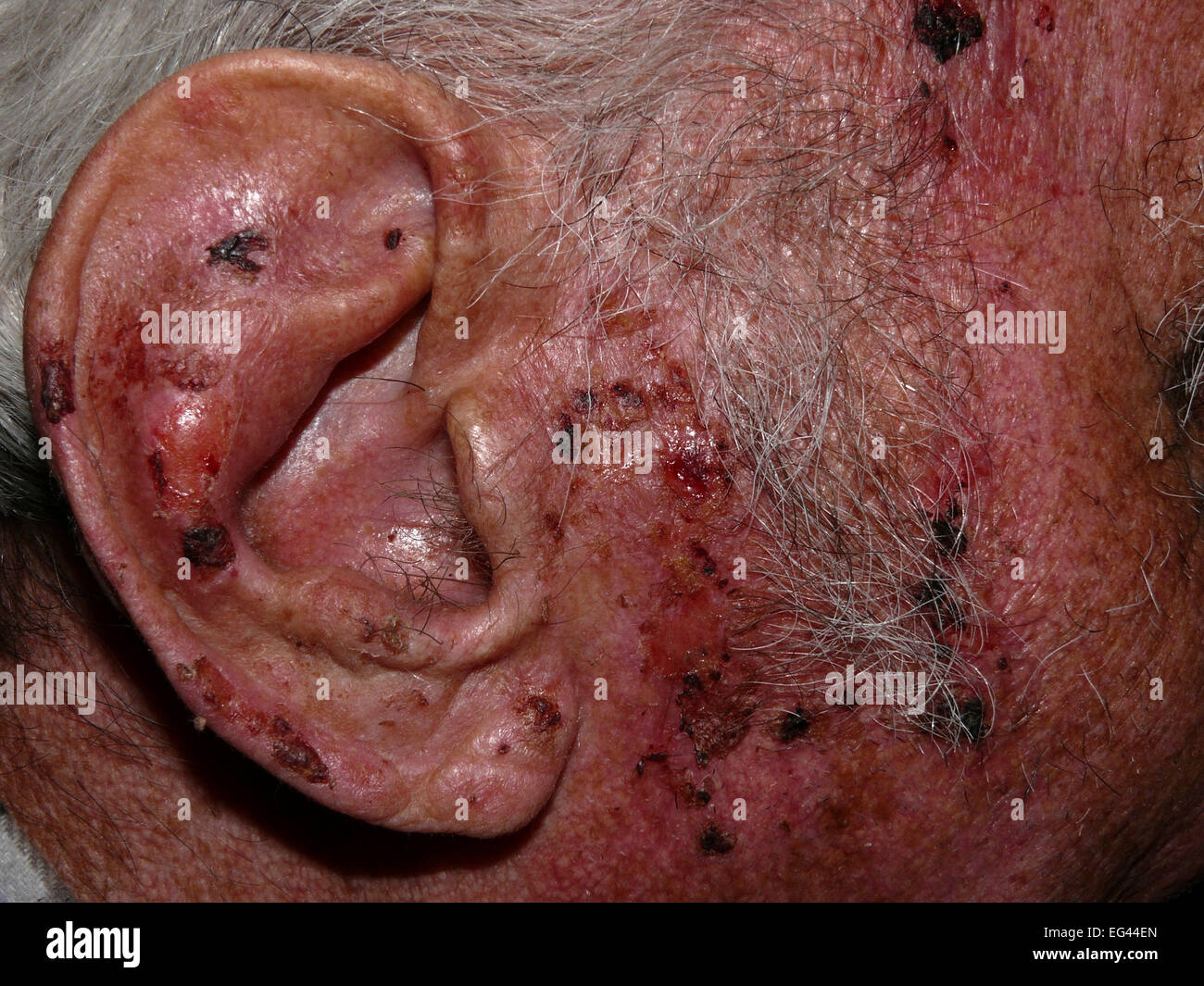 Squamous-cell carcinomas of the face and ear Stock Photo