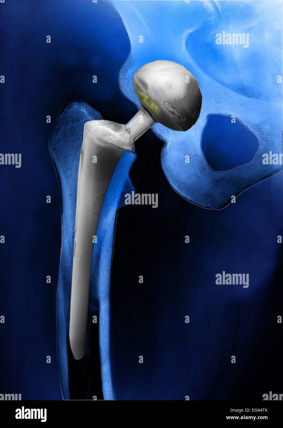 Hip prosthesis, endoprosthesis of the hip joint, hip replacement, X-ray Stock Photo