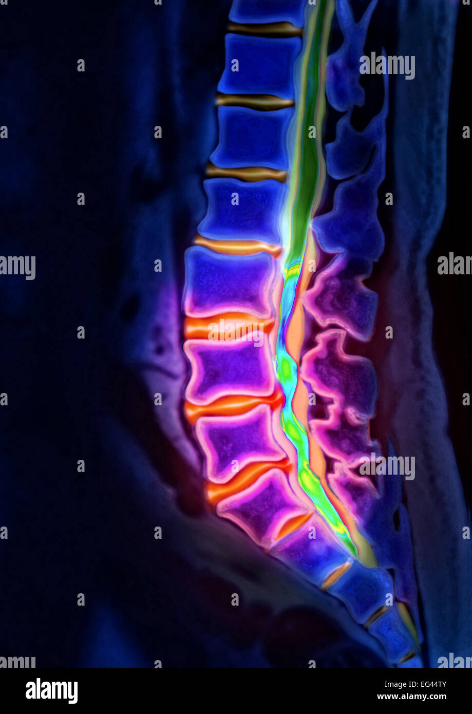 Herniated disk, lumbar vertebra, computed tomography Stock Photo