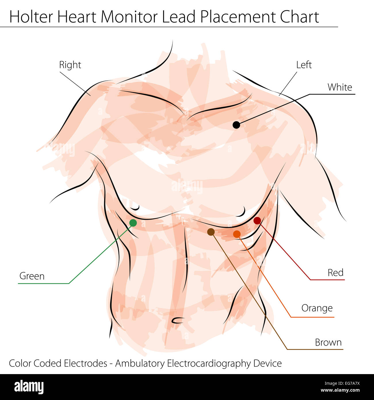 cardiac monitor lead placement