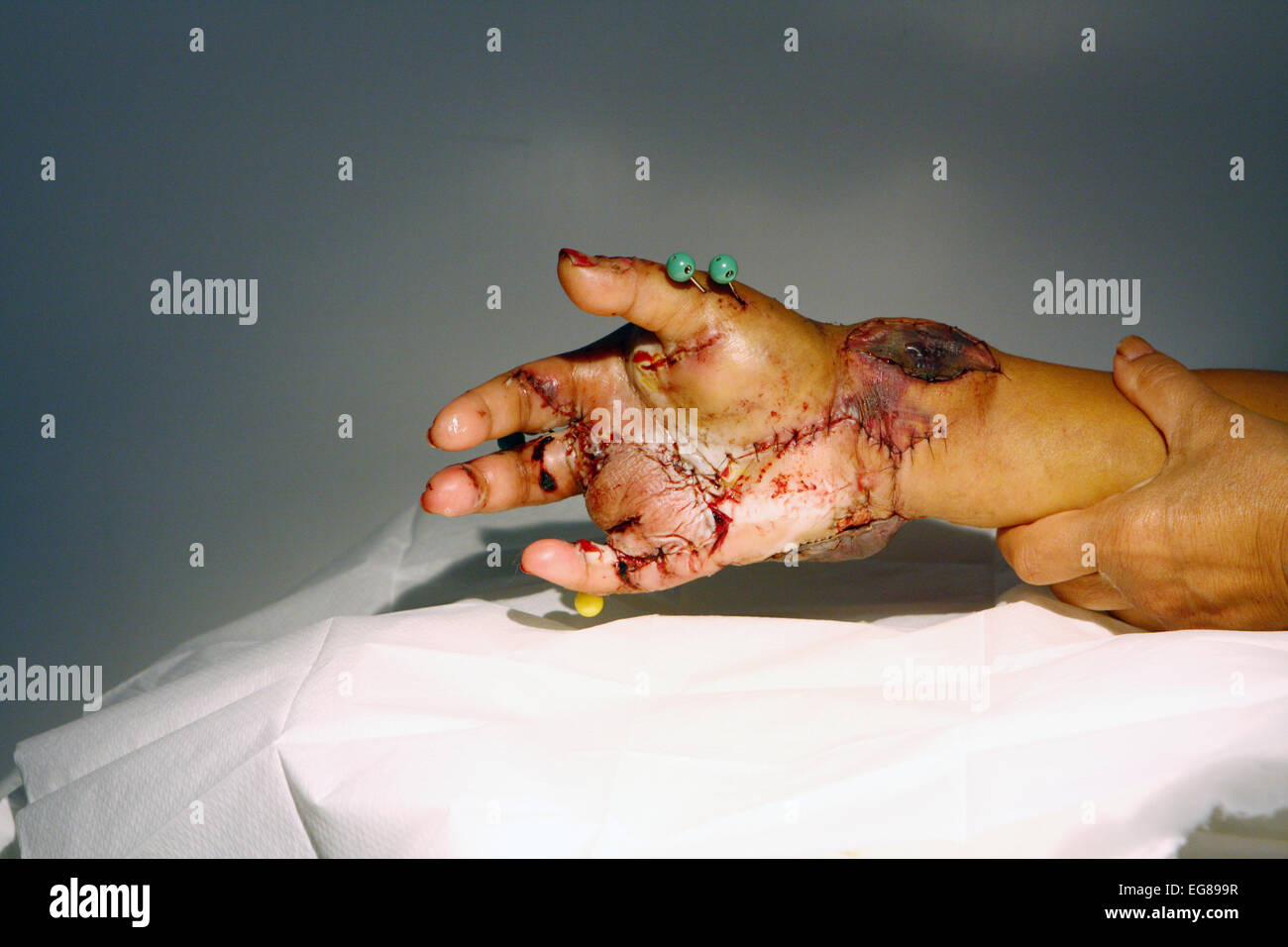 A severely injured hand 7 days after completion of a 15 hour operation. Stock Photo