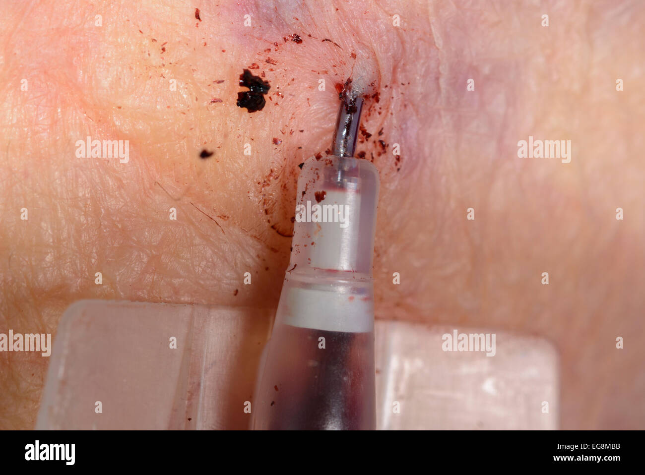 Catheter from a cannula sticking into a woman's arm. Stock Photo
