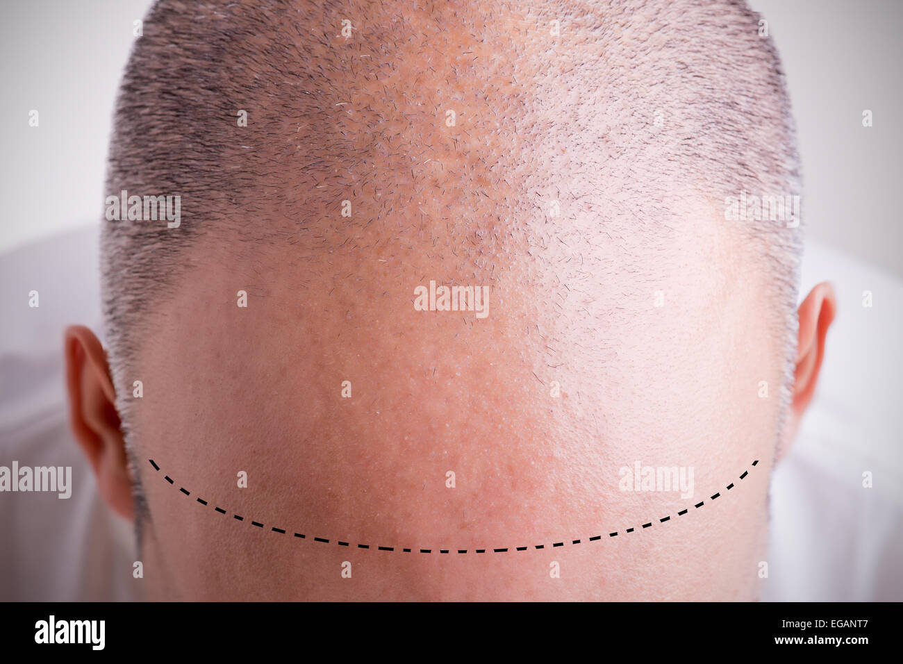 Top view of a men's head with a receding hair line with a marked hairline Stock Photo