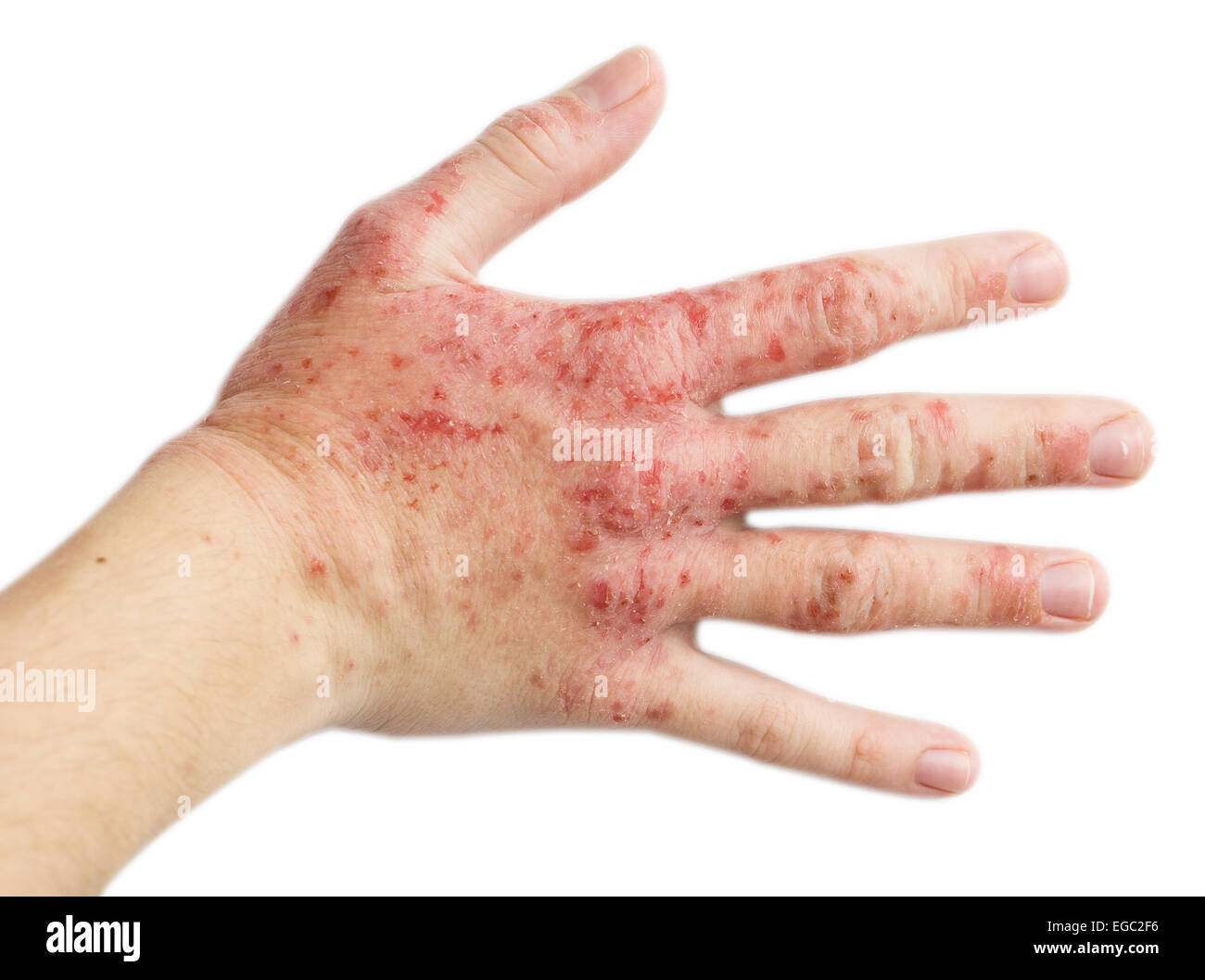 The problem with many people - eczema on hand. Isolated background Stock Photo
