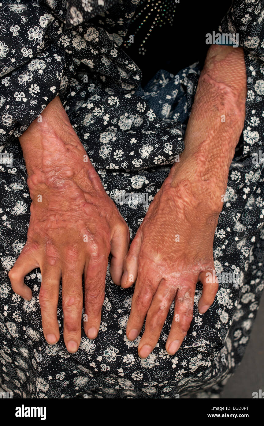 Severely burnt hands of a woman who was held down by her motherinlaw