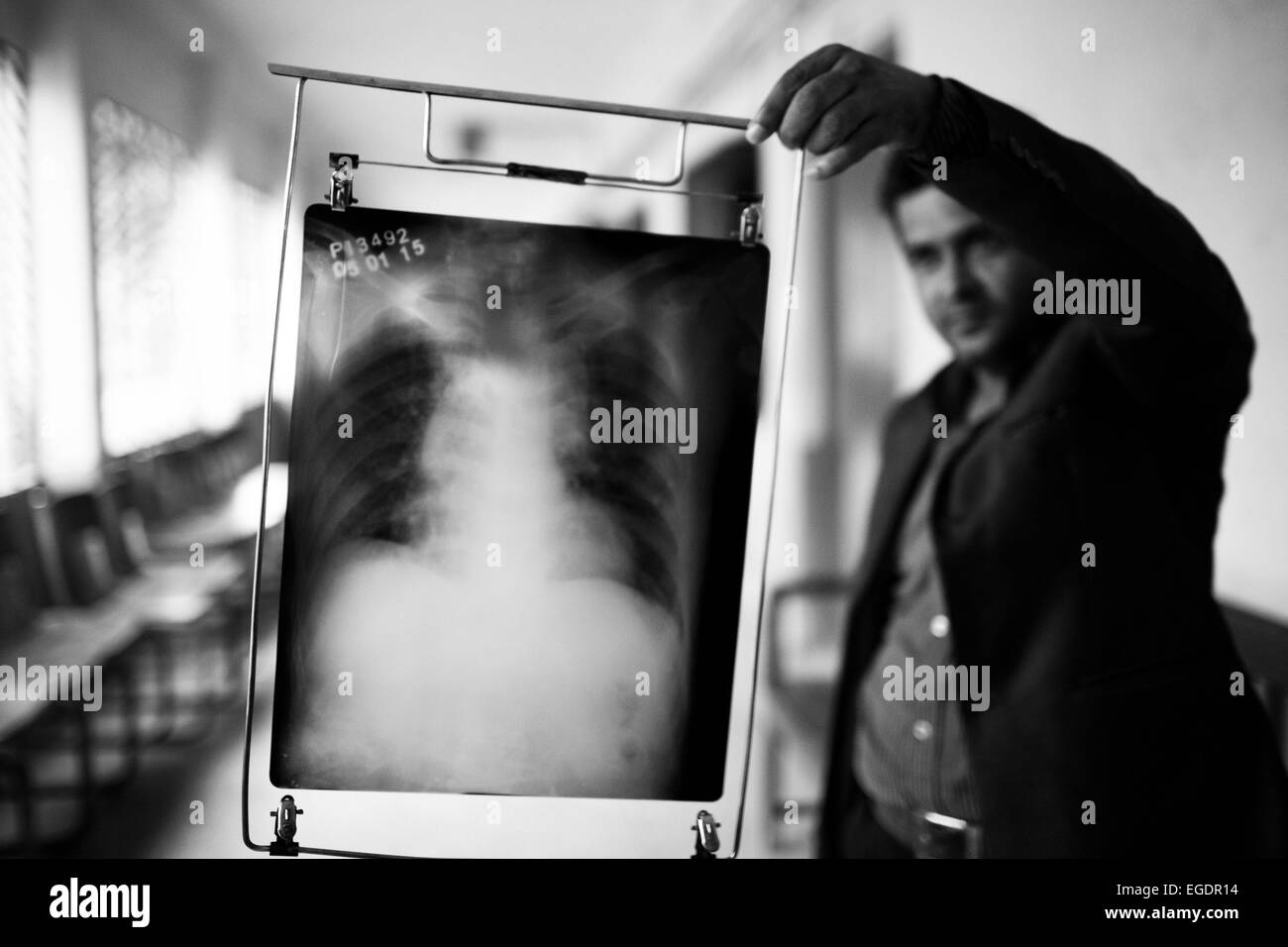 Jan. 5, 2015 - Tuberculosis (TB) is a worldwide public health problem