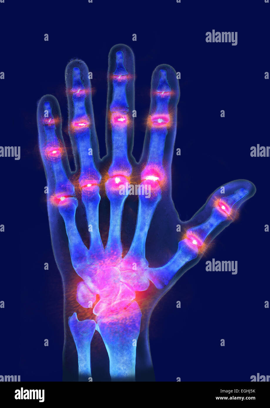 Hand of a person suffering from gout, pain zones, illustration Stock Photo