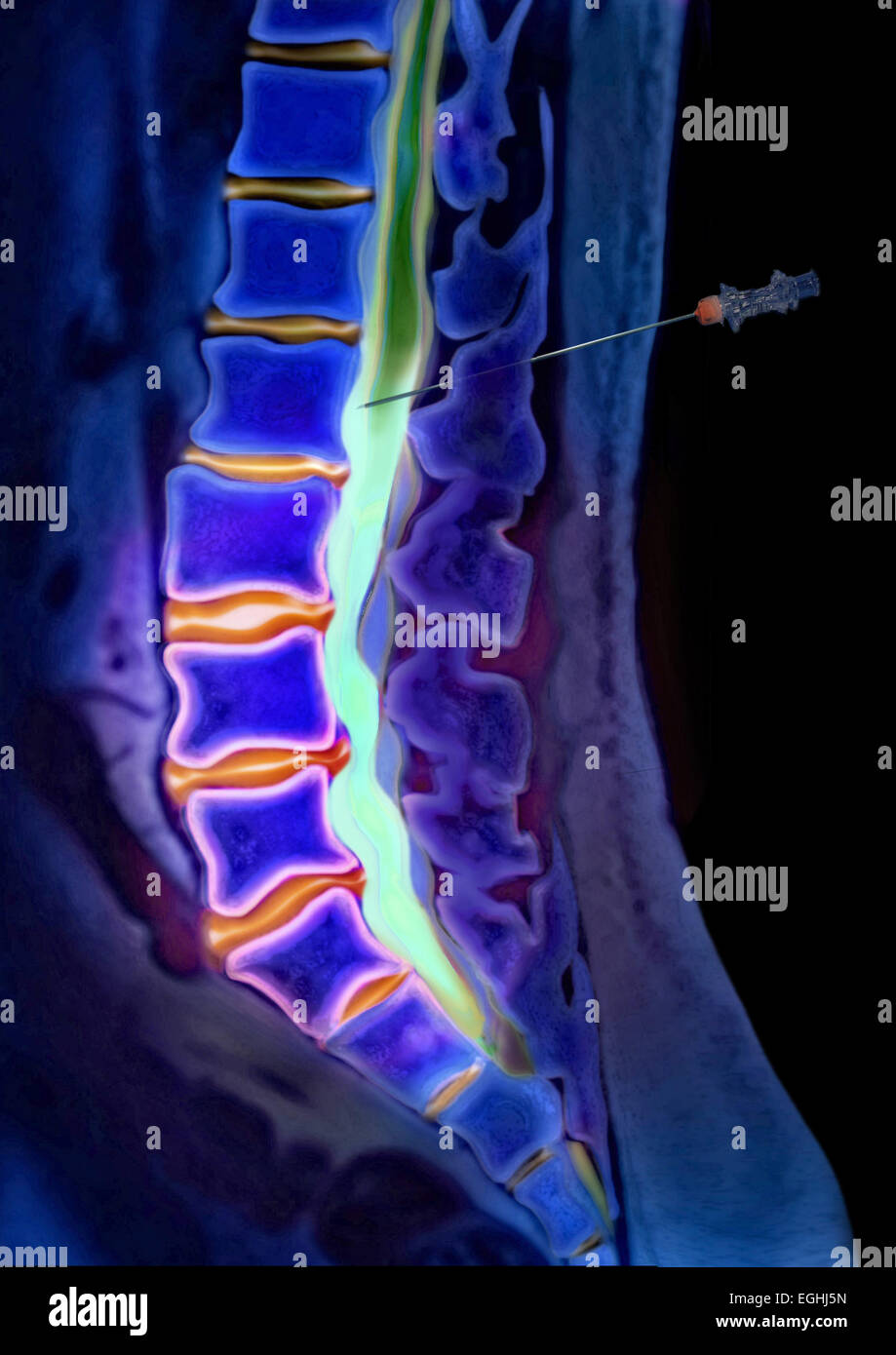 Contrast solution, lumbar vertebrae, myelography, herniated disc, illustration Stock Photo