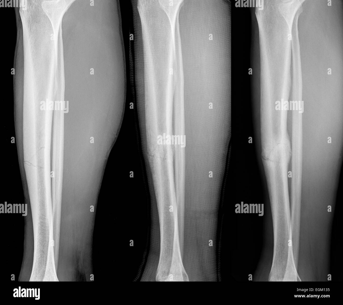 Sequence showing an uncomplicated fracture of tibia showing left to right Day 1, 65 days and 107 days post trauma showing bone c Stock Photo
