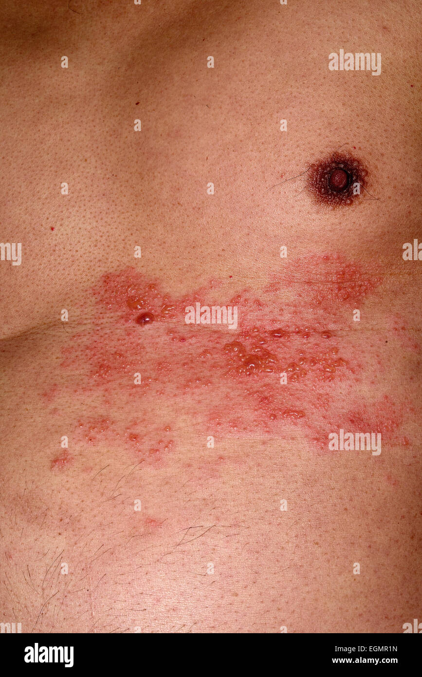 Shingles In Chest Shingles or herpes zoster in the chest area of a man, 56 years, several ...