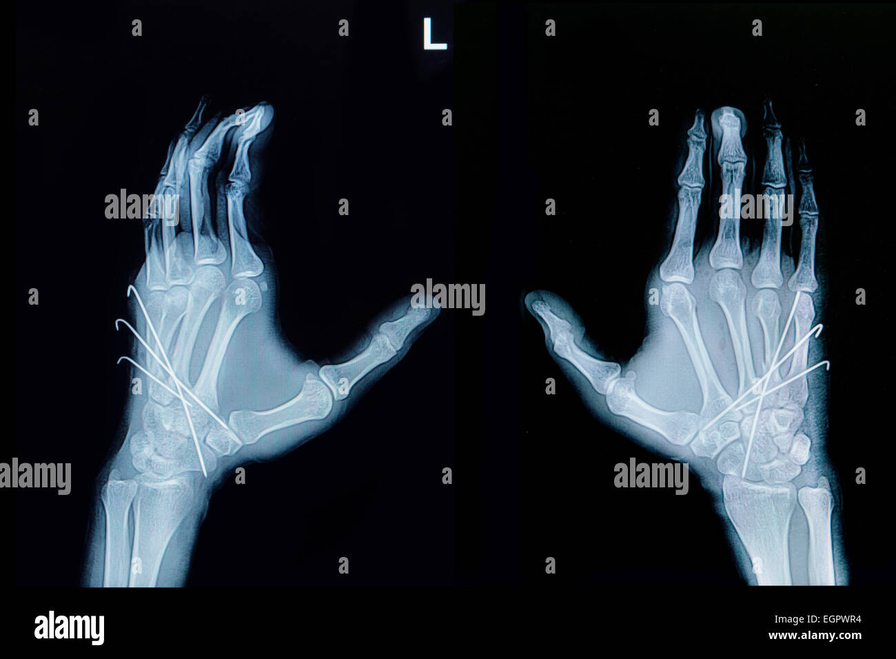 Film x-ray of hand fracture : show fracture metacarpal bone insert with k-wire (Kirschner wire) Stock Photo