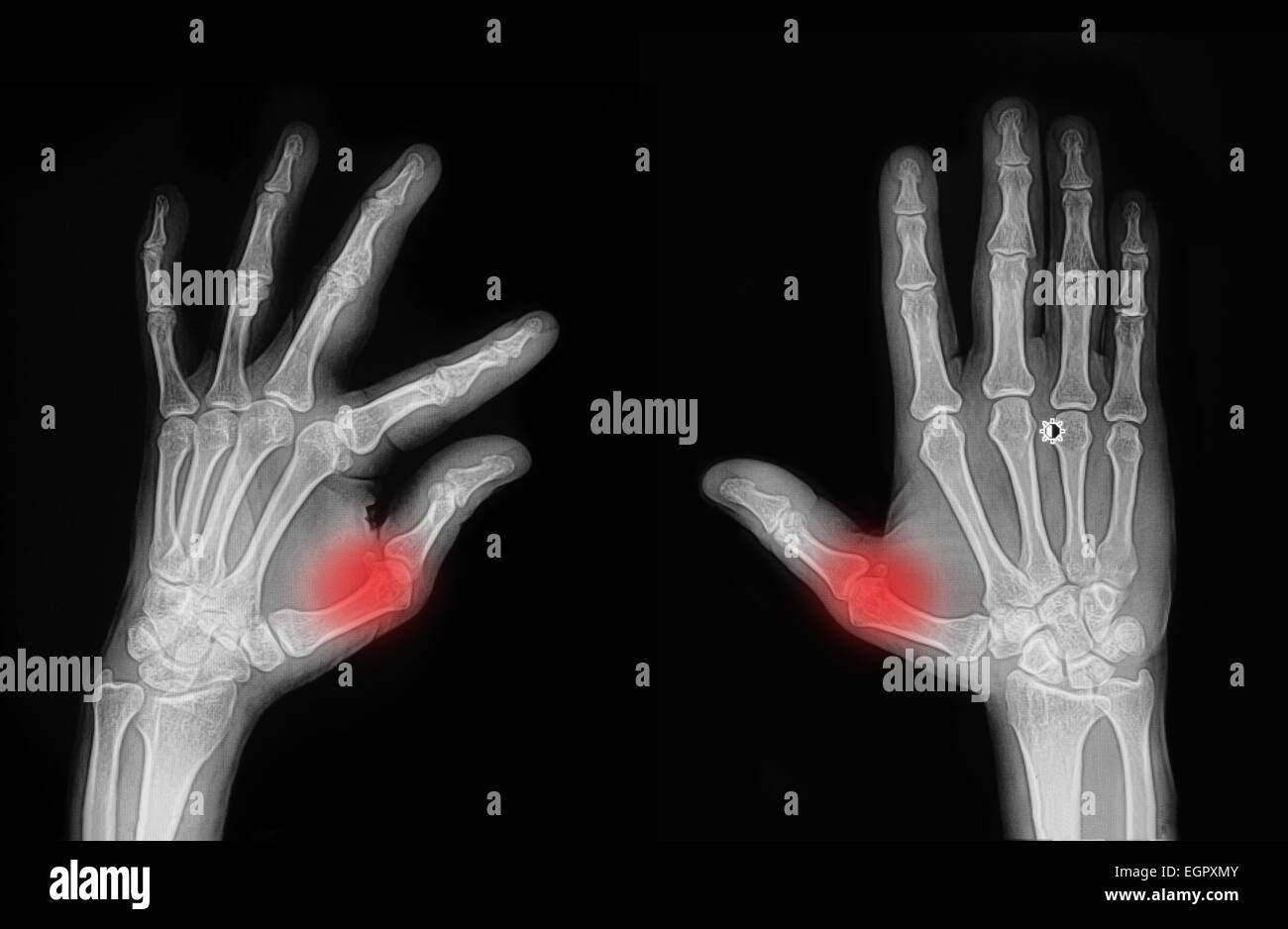 Broken Index Finger X Ray
