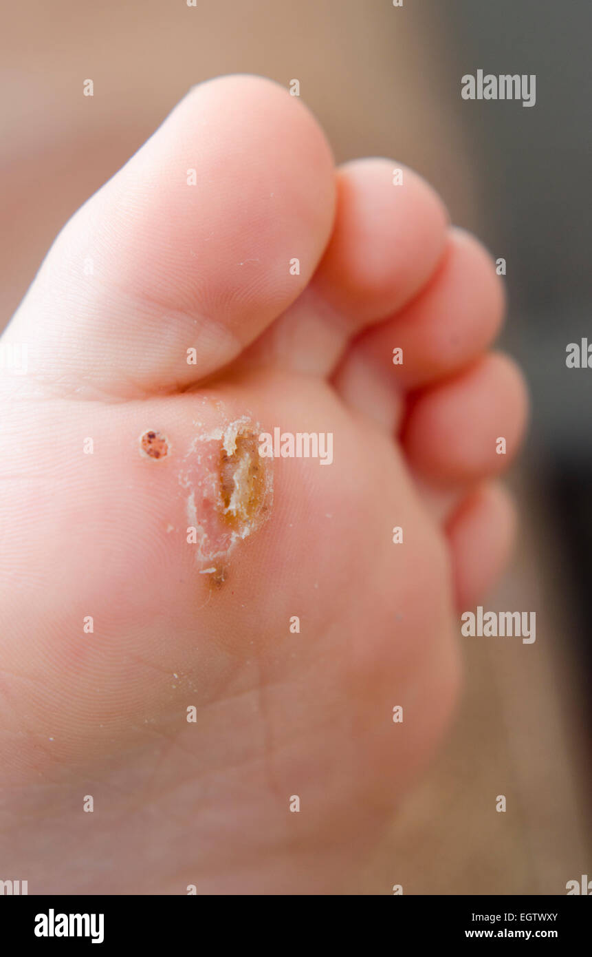 Verruca plantar wart on a child's foot. Stock Photo