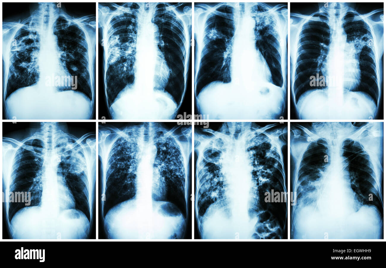 Pulmonary Tuberculosis Collection .  Chest X-ray : show patchy infiltration , interstitial infiltration , alveolar infiltration Stock Photo