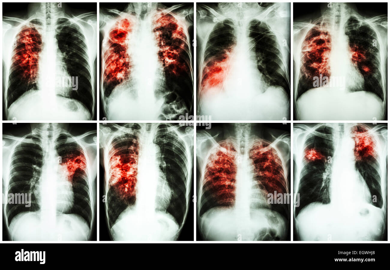 Pulmonary Tuberculosis Collection .  Chest X-ray : show patchy infiltration , interstitial infiltration , alveolar infiltration Stock Photo