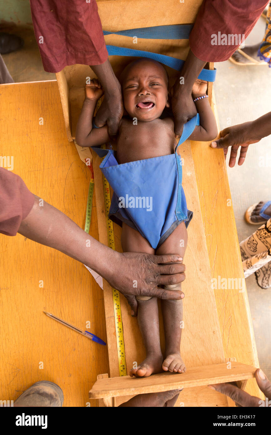 KOMOBANGAU, TILLABERI PROVINCE, NIGER, 15th May 2012: A child with severe malnutition is treated at the local health centre's weekly clinic. Stock Photo