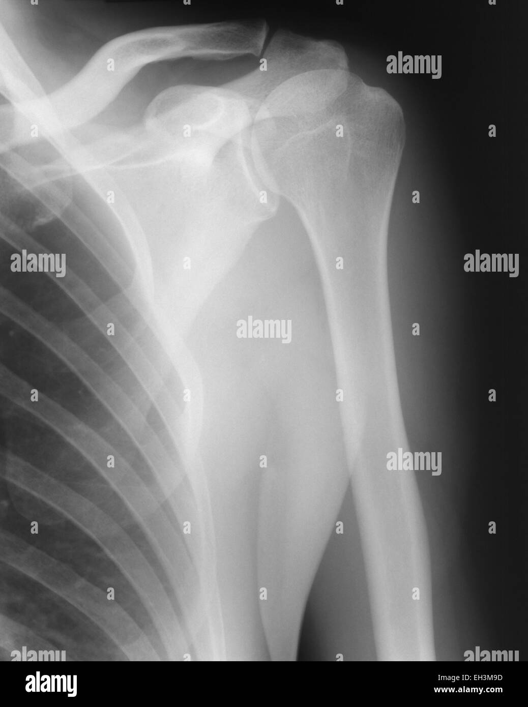 X-Ray image of left shoulder Stock Photo