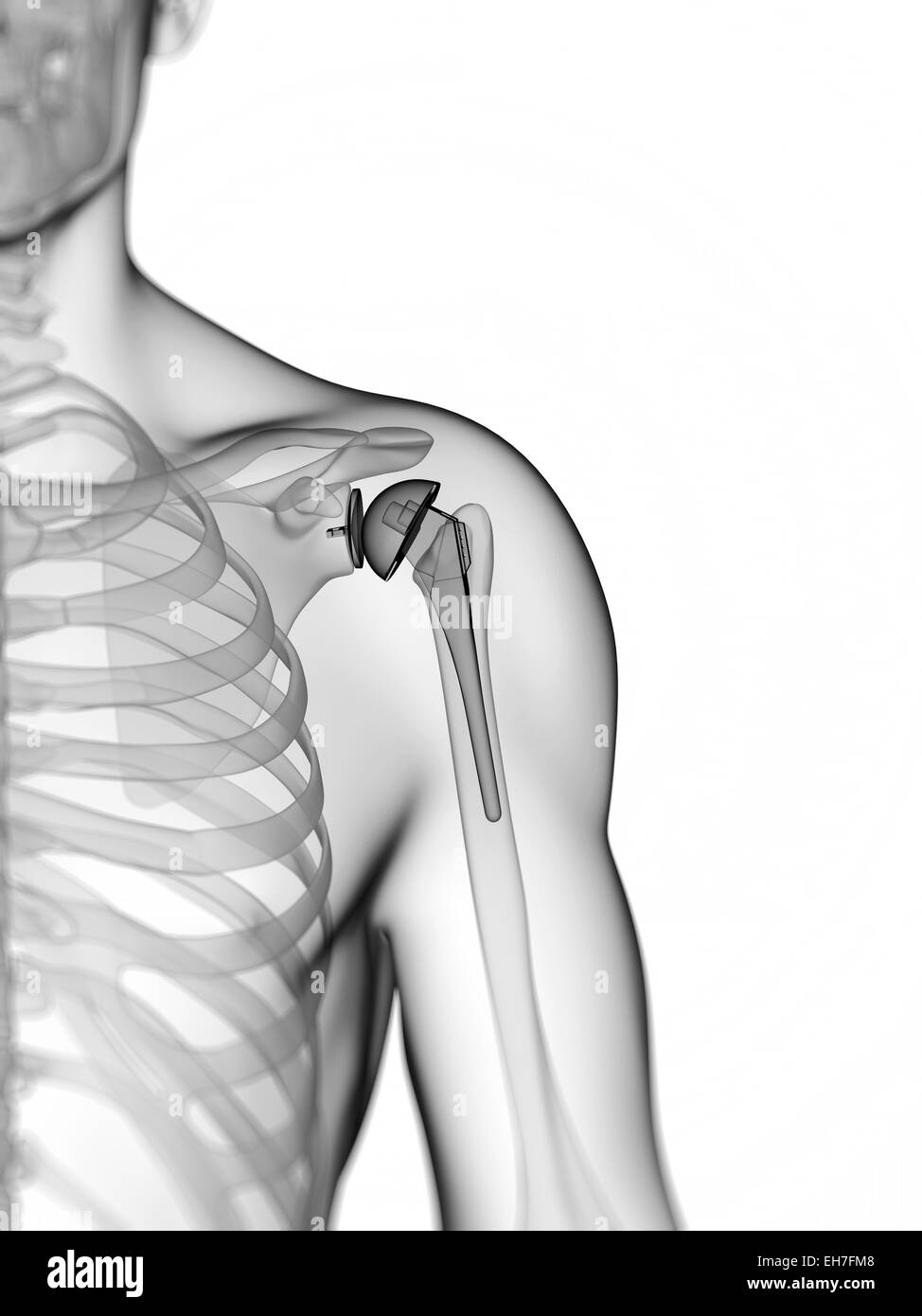 Arthroplasty shoulder Black and White Stock Photos & Images - Alamy