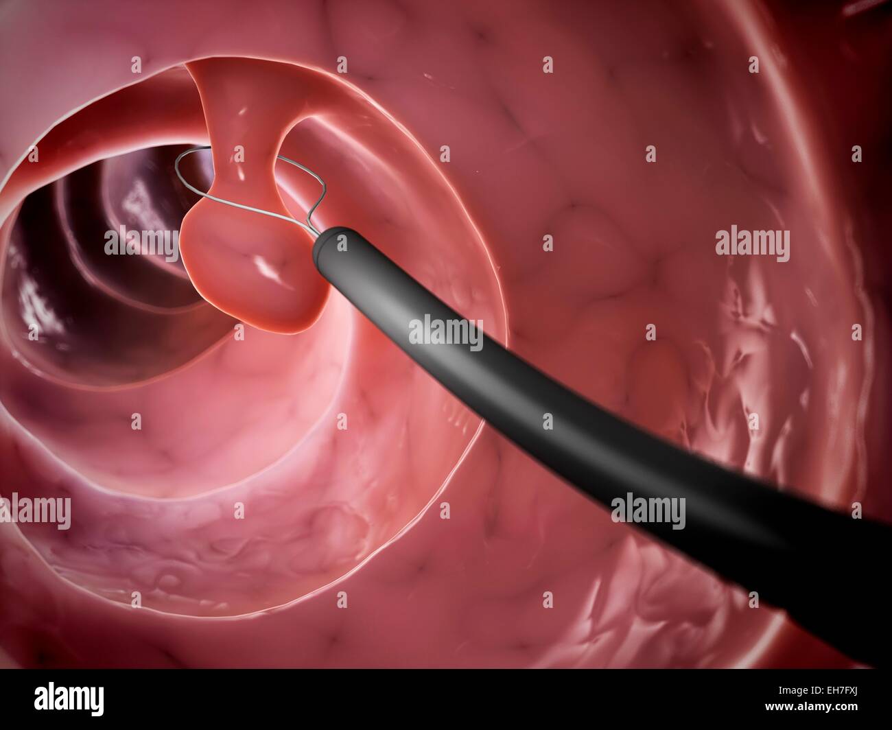 Removal of polyp, artwork Stock Photo