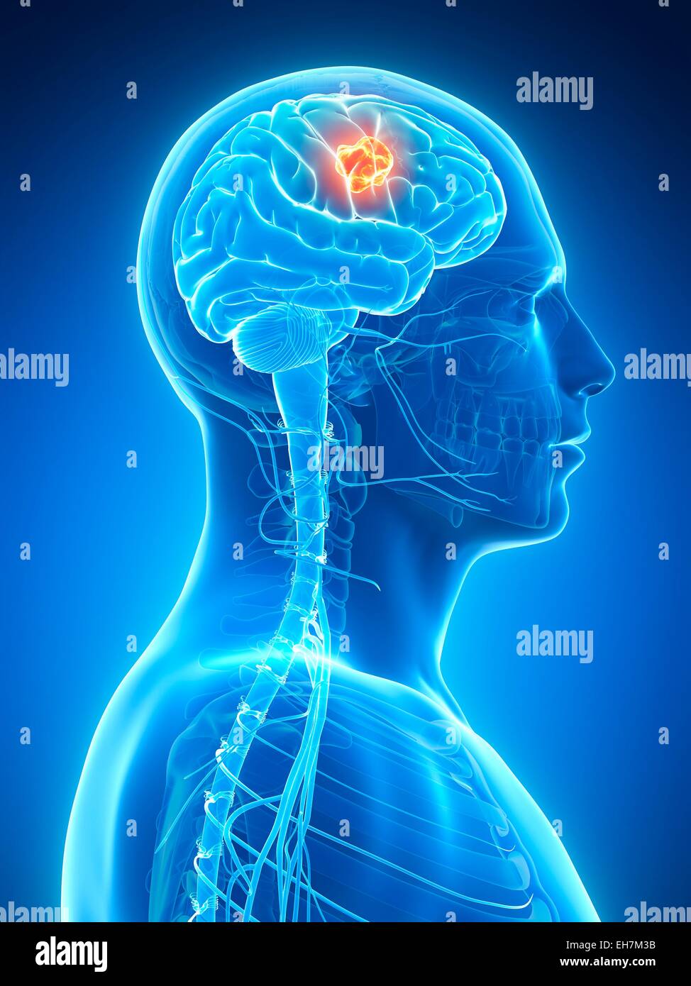 Human brain tumor, illustration Stock Photo Alamy