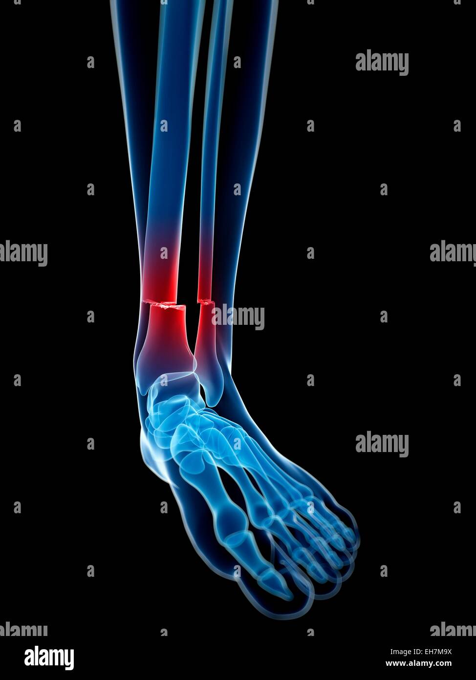 Broken leg bone, illustration Stock Photo - Alamy