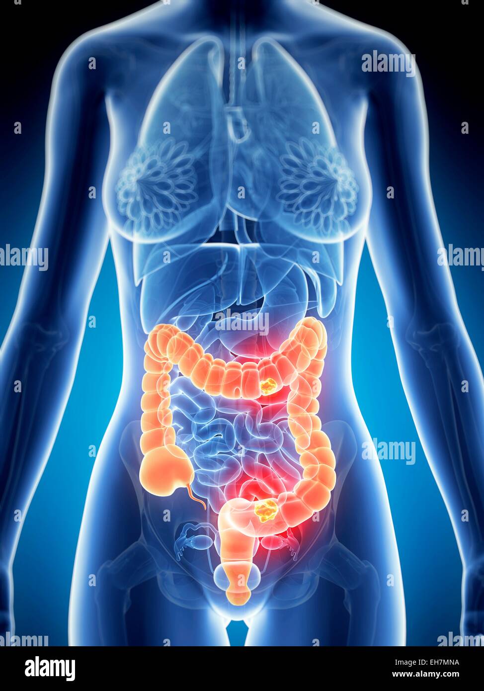 Damage Colon Human colon cancer hi-res stock photography and images - Alamy