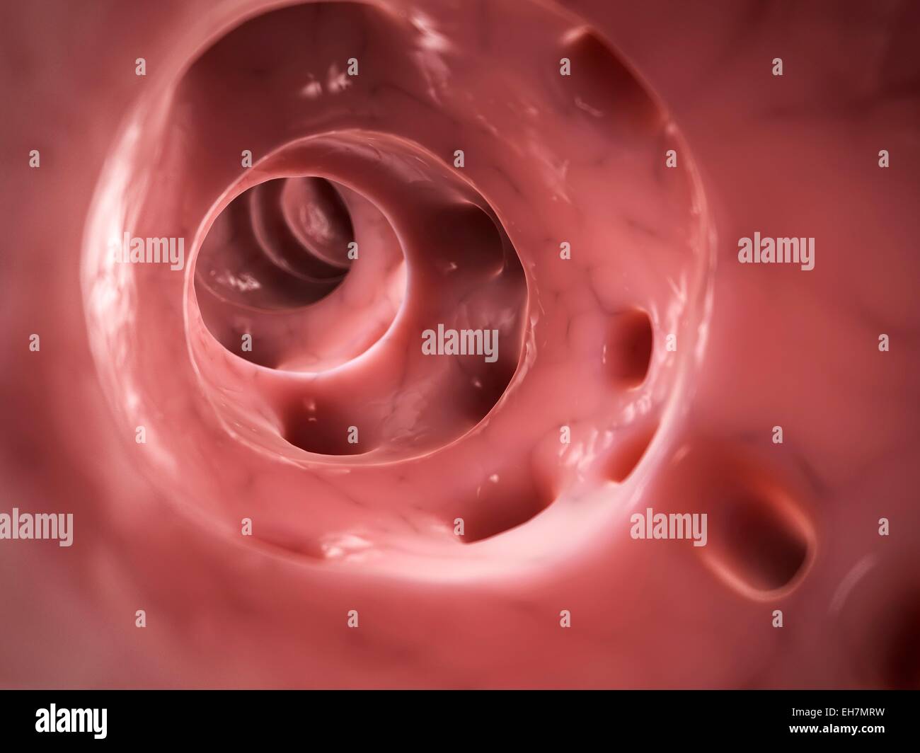 Diverticulitis, illustration Stock Photo Alamy
