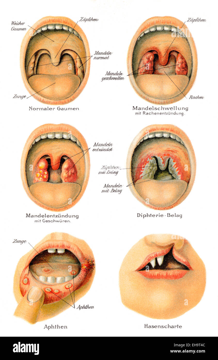 Mouth and throat diseases, health counselor, 19th century, Mund- und Rachenkrankheiten, Gesundheitsratgeber, 19. Jahrhundert Stock Photo