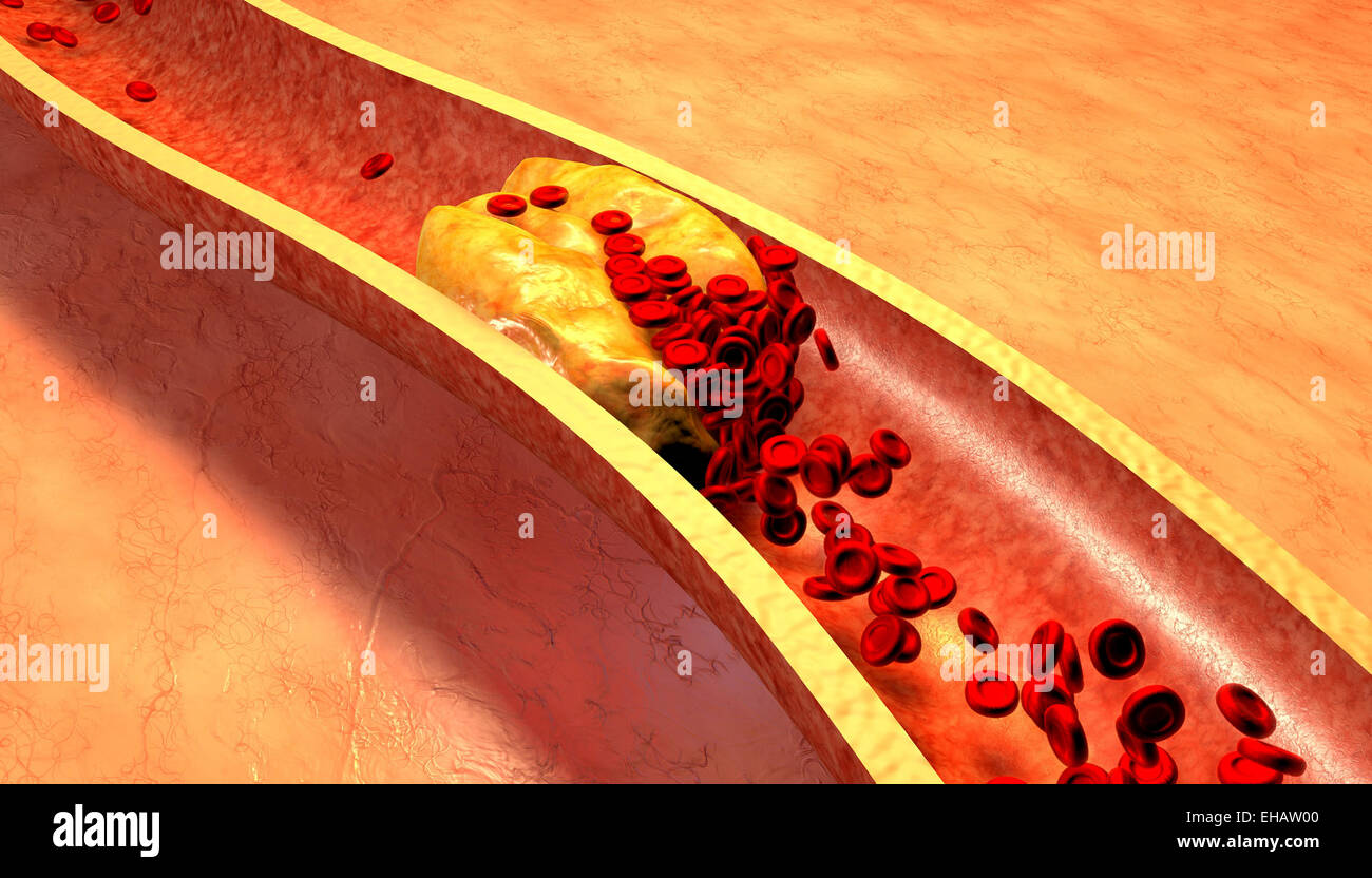Clogged Artery with platelets and cholesterol plaque Stock Photo Alamy