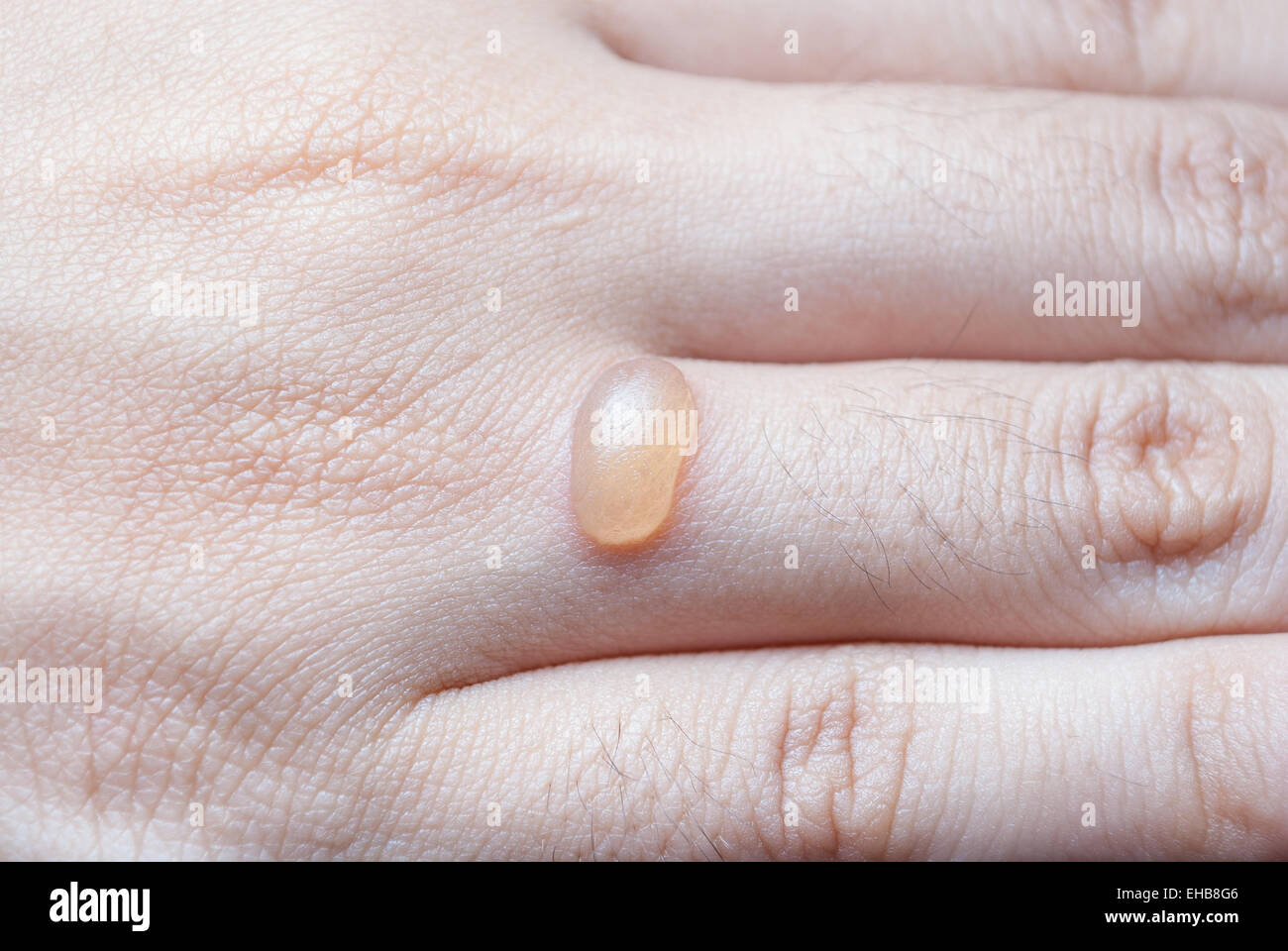 Blister skin hires stock photography and images Alamy