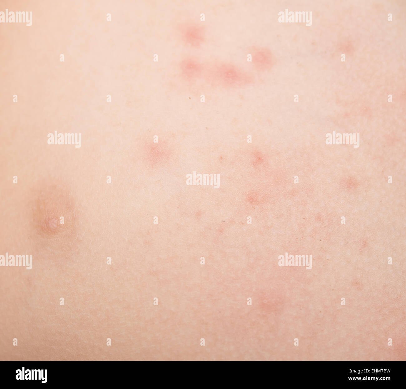 rash on human skin Stock Photo