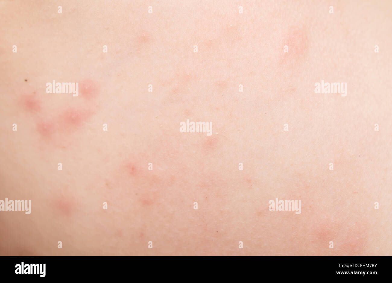 rash on human skin Stock Photo