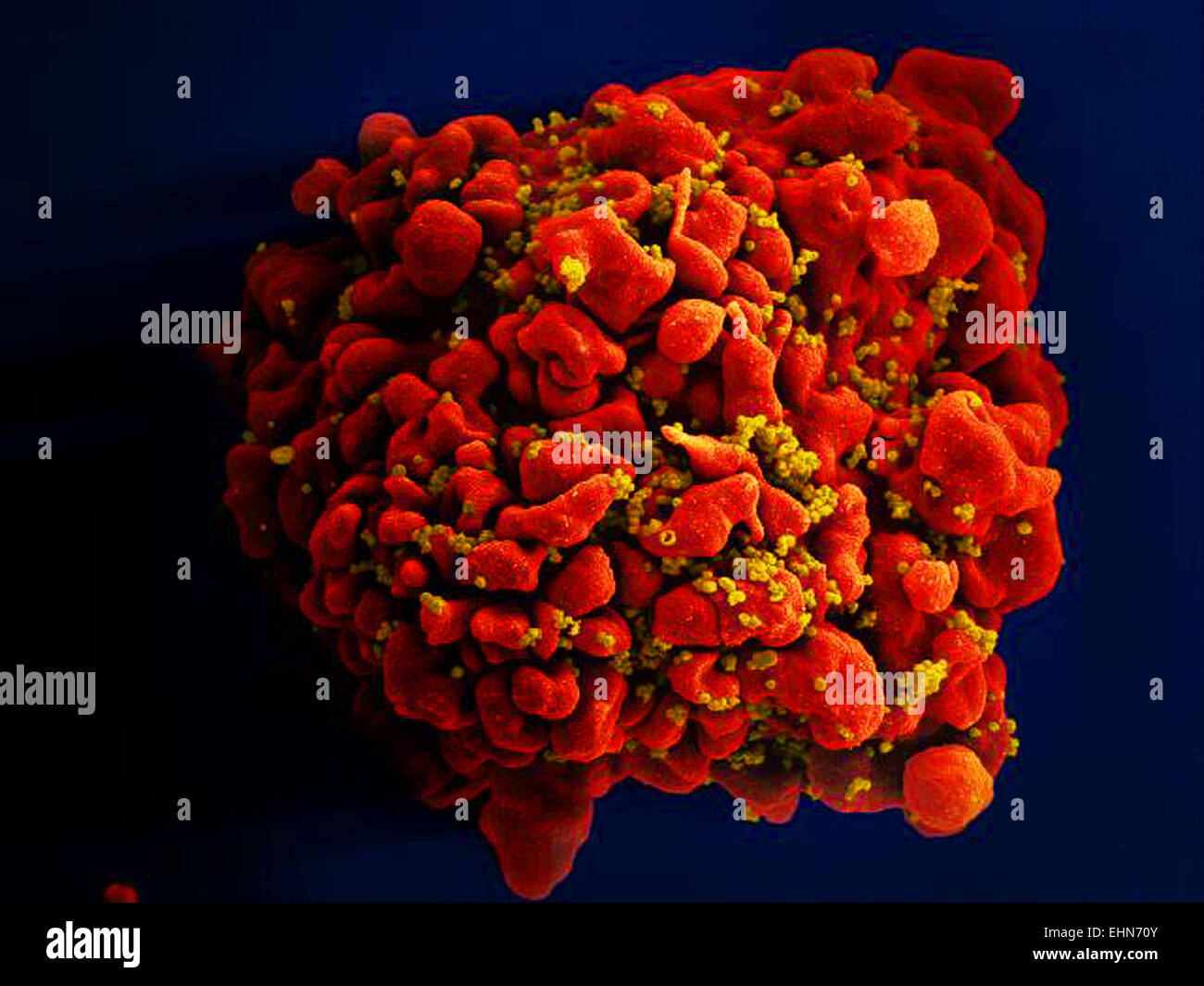 H9-T cell infected by numerous, spheroid-shaped, human immunodeficiency virus (HIV) particles, which can be seen sttached to the cell's surface membrane, (SEM). Stock Photo
