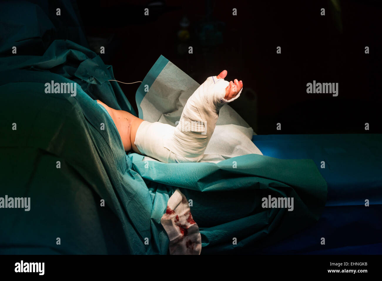 Laying a cast after hand surgery. Stock Photo