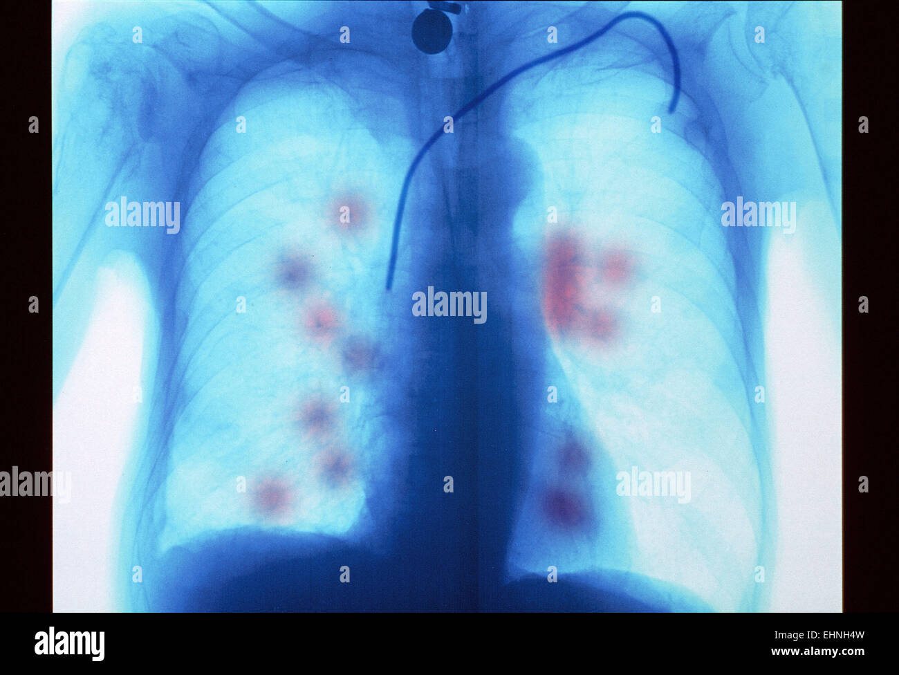 Secondary lung cancer. Coloured X-ray of a patient with metastatic (secondary) lung cancer . Stock Photo