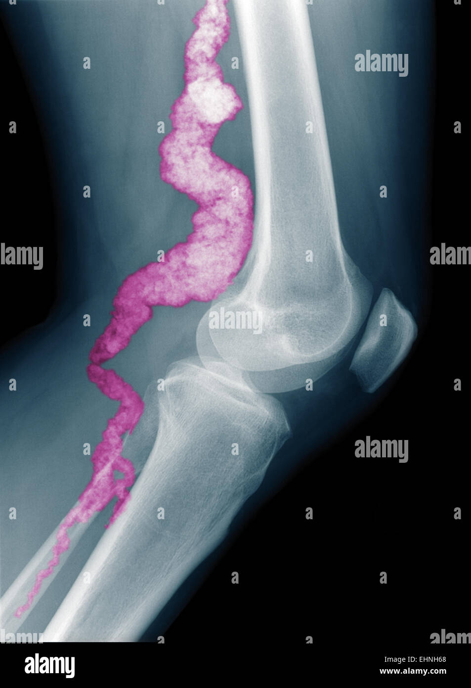 A knee x-ray of a patient with ACDC, a rare calcification disorder, reveals calcification in the main artery supplying blood to the lower leg. Stock Photo