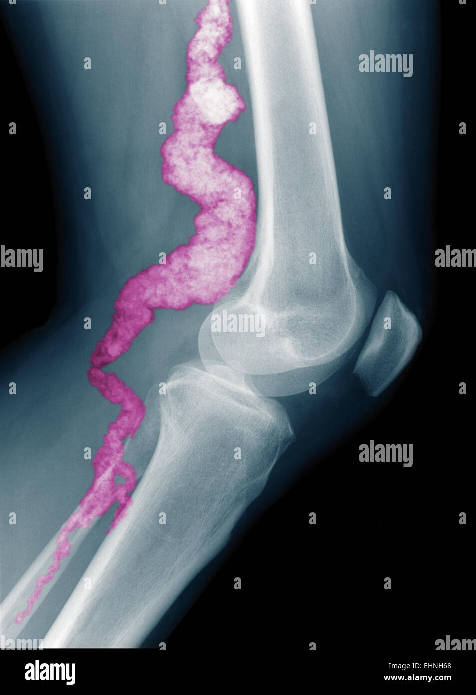 Calcification artery hires stock photography and images Alamy