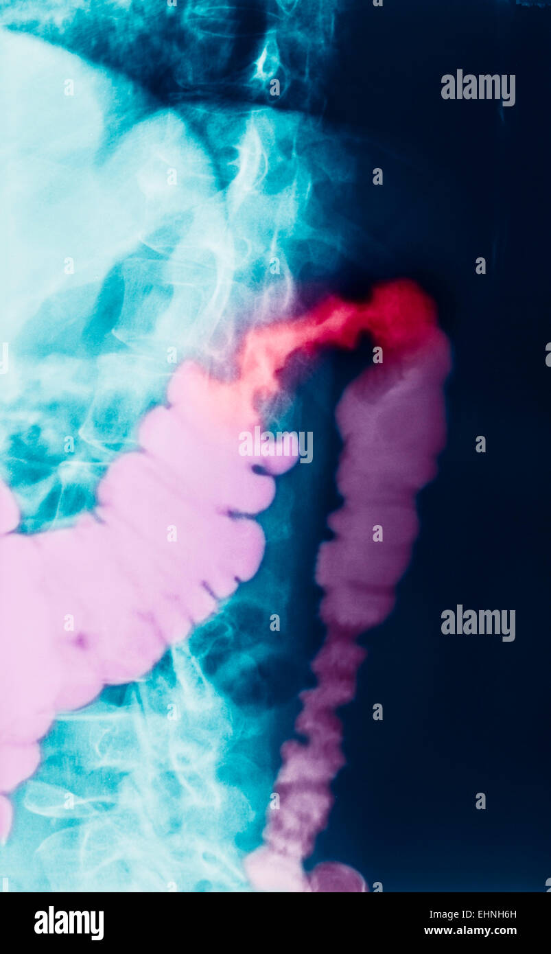 Color enhanced x-ray of a patient with colon cancer. Stock Photo
