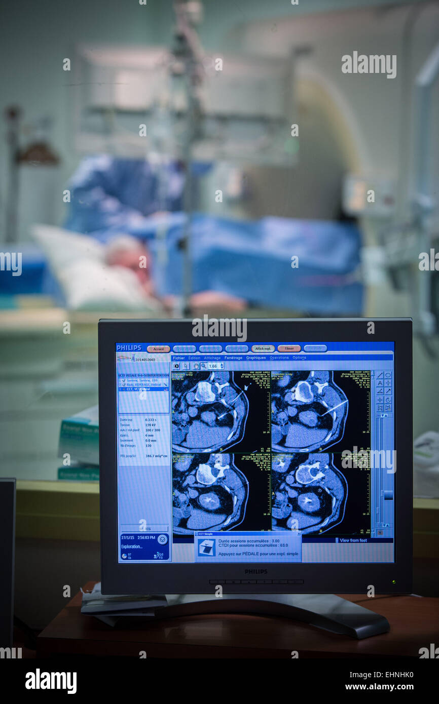 CT scan-assisted cryotherapy to destroy a kidney tumor, Saint-Louis hospital, Paris, France. Stock Photo