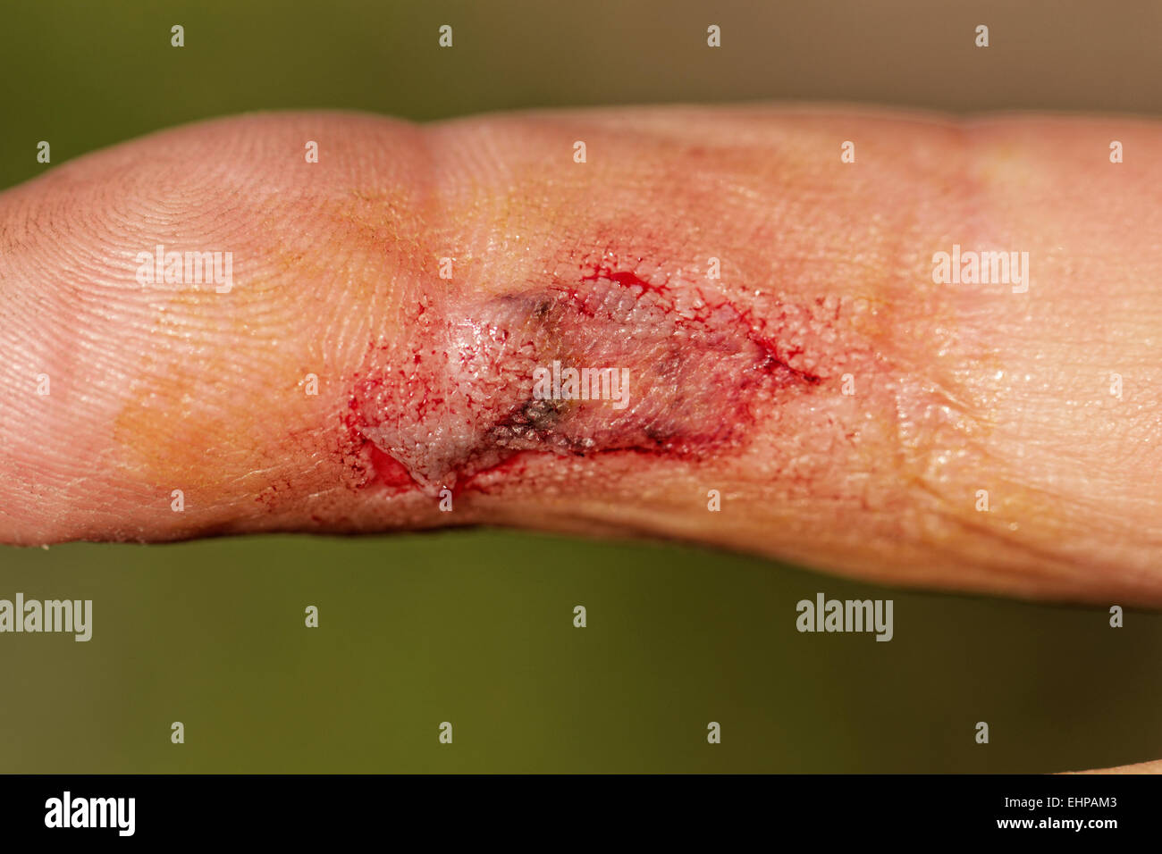 Flesh wound with blood on male finger Stock Photo