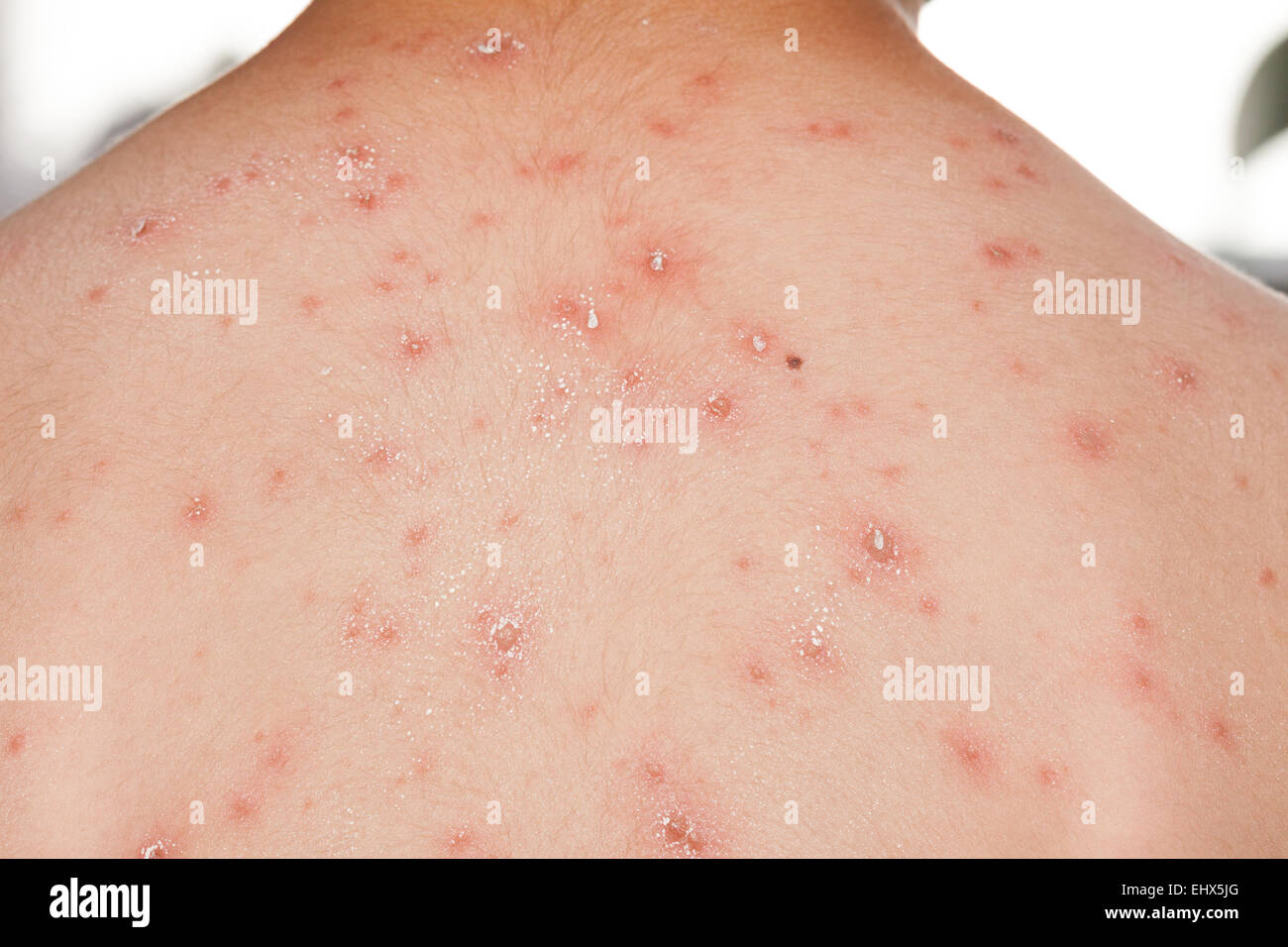 Detail baby with chicken pox rash Stock Photo - Alamy