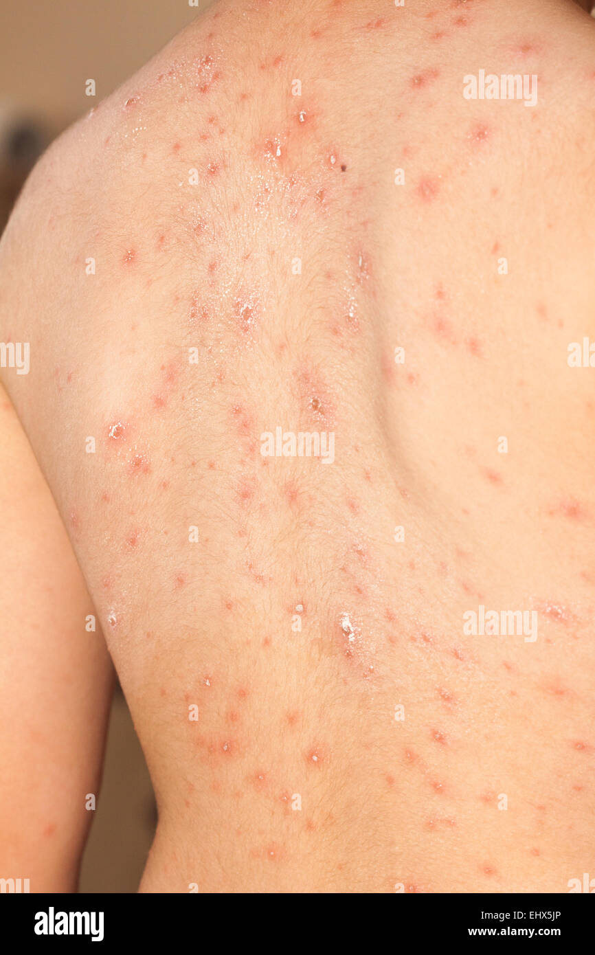 Detail baby with chicken pox rash Stock Photo - Alamy