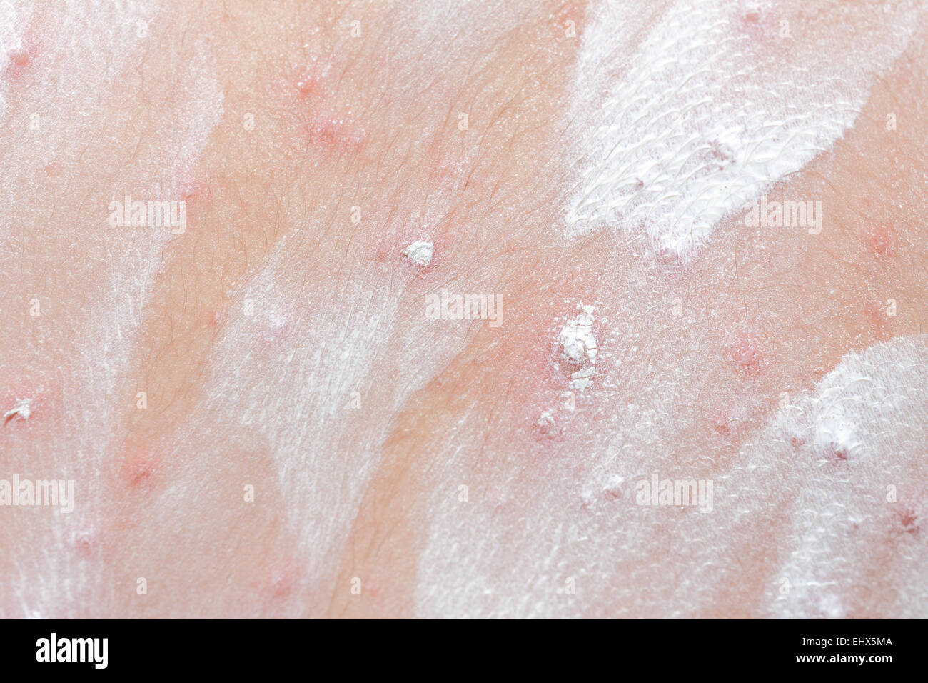 Detail baby with chicken pox rash Stock Photo - Alamy