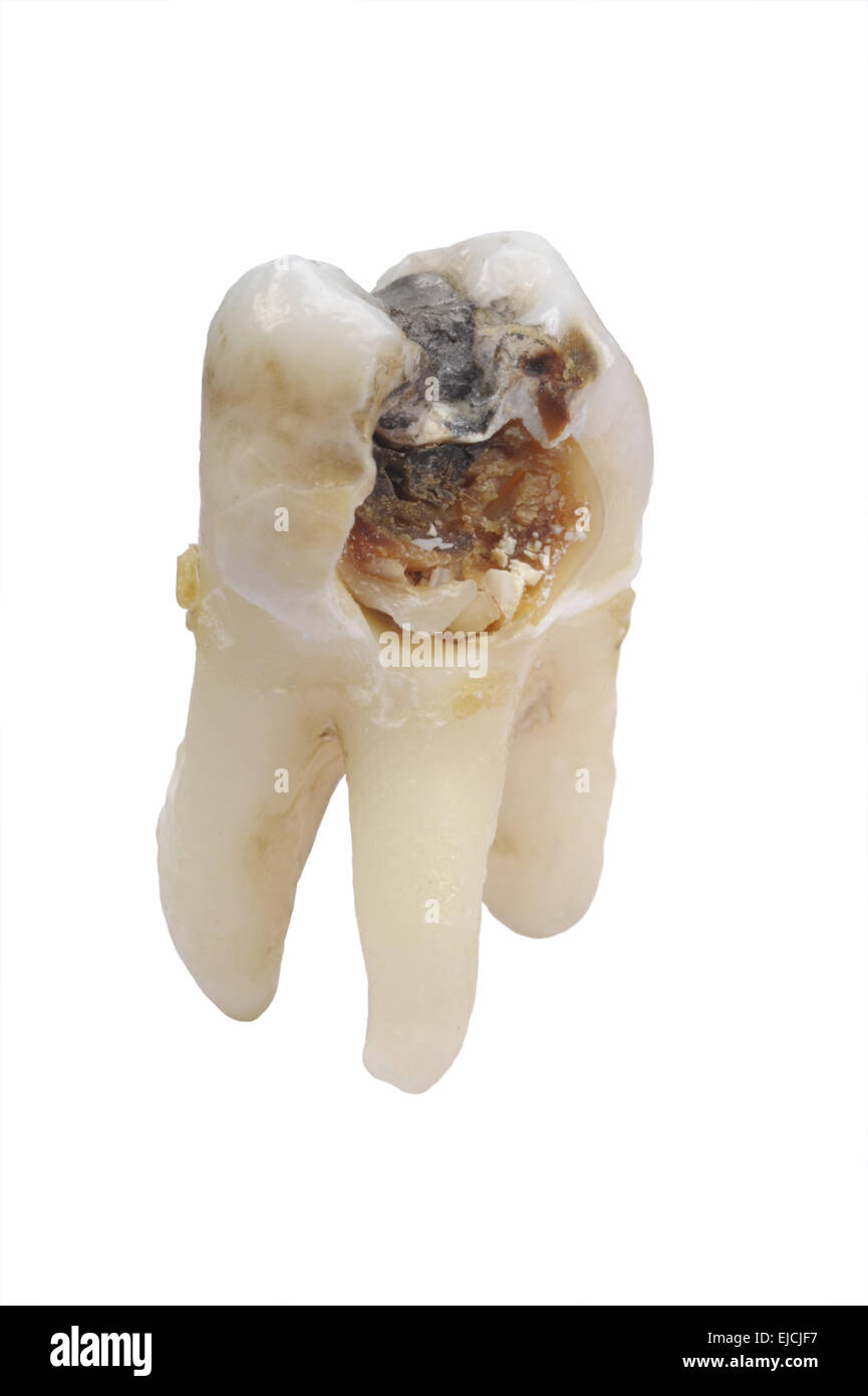 extracted tooth with dental caries Stock Photo